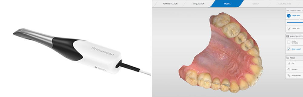 口腔内スキャナーで負担の少ない型取り・診断